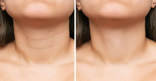 Before and after comparison of neck skin texture on a person.